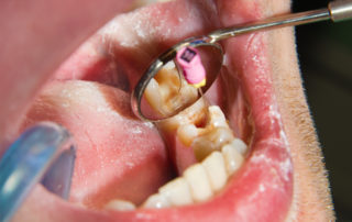 open mouth with bad teeth and dental instruments