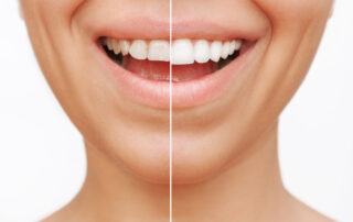 Close up of a young smiling woman before and after veneers are installed.