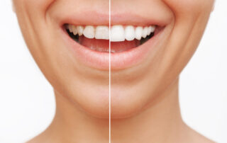 Close up of a young smiling woman before and after veneers are installed.