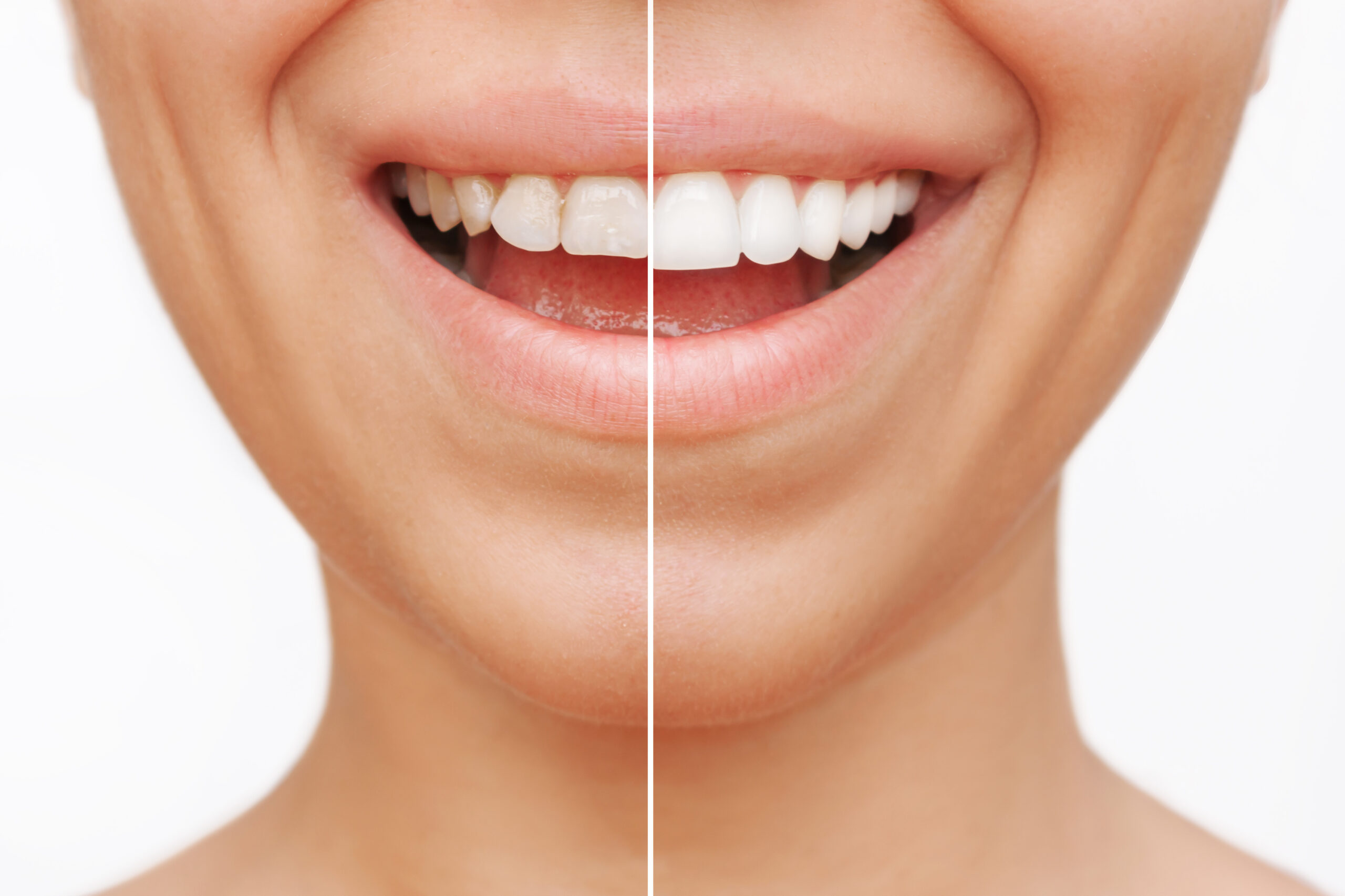 Close up of a young smiling woman before and after veneers are installed.