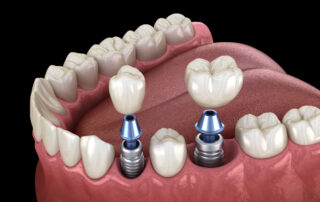 Premolar and Molar tooth crown installation over dental implant