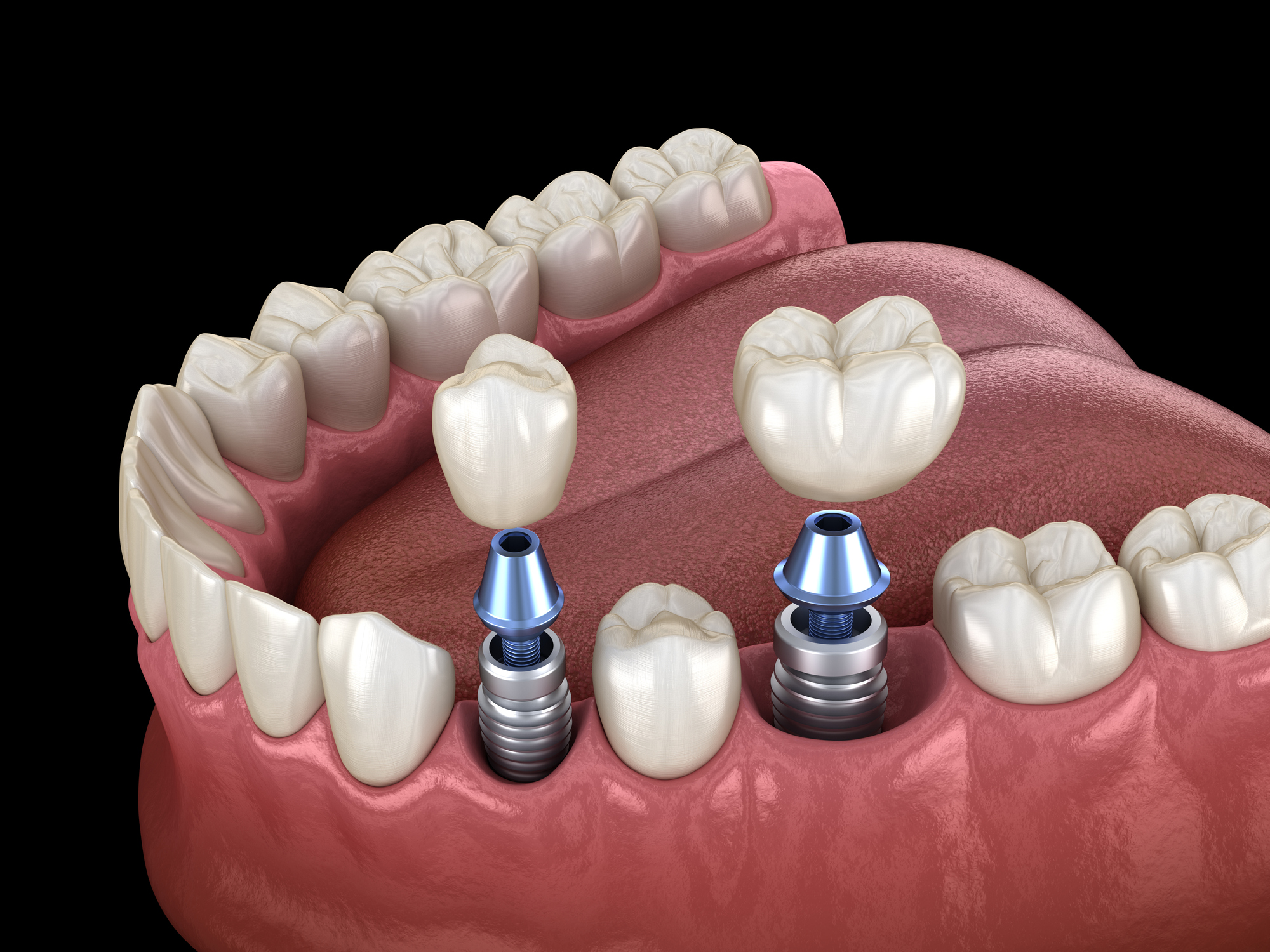 Premolar and Molar tooth crown installation over dental implant