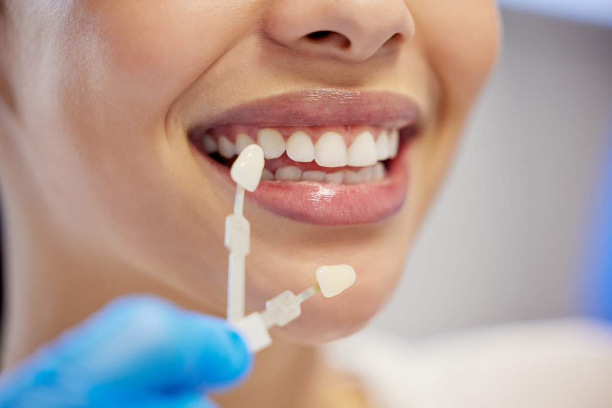 woman getting dental veneers