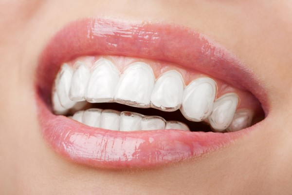 Smiling mouth with teeth-whitening tray