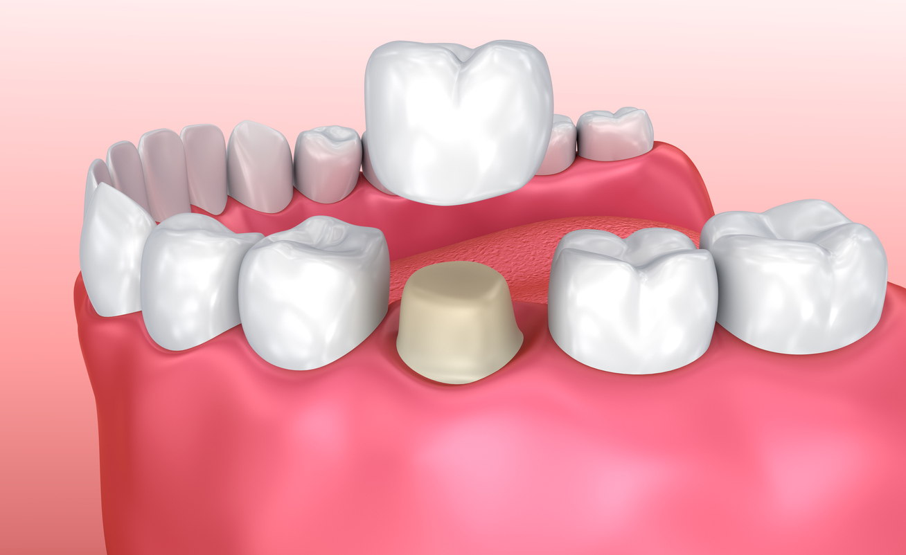 A dental crown illustration in 3-D to depict the difference between dental onlays vs. crowns - Creekview Dental