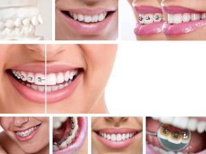 Invisalign versus braces