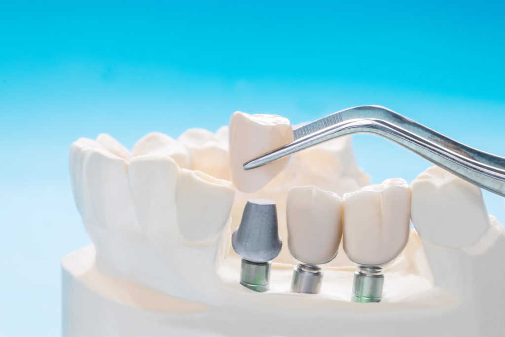 Creekview Dental - Dental Implants