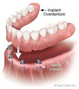 Dentures Traditional Versus Implant