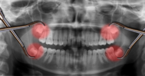 Wisdom Tooth Extraction